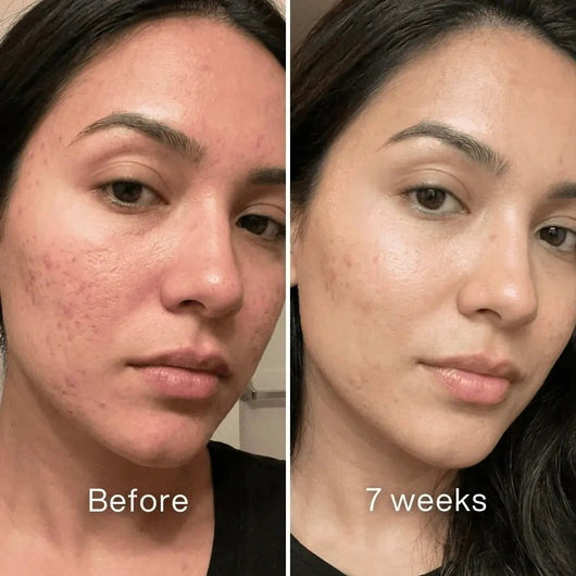 🧴Clinical Acne Scar Repair Stick✨