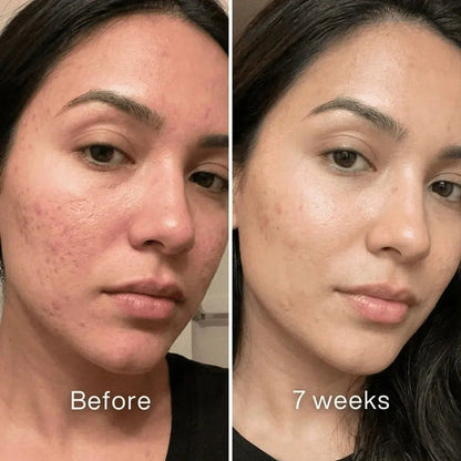 🧴Clinical Acne Scar Repair Stick✨