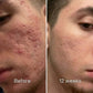 🧴Clinical Acne Scar Repair Stick✨