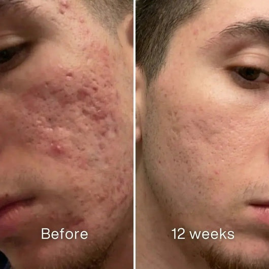 🧴Clinical Acne Scar Repair Stick✨