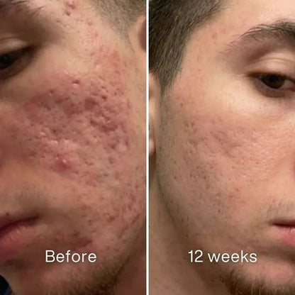 🧴Clinical Acne Scar Repair Stick✨